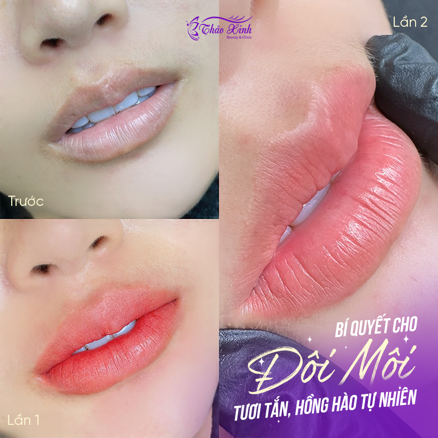 Phun Môi Collagen Là Gì? Bí Quyết Cho Đôi Môi Tươi Tắn, Hồng Hào Tự Nhiên 2