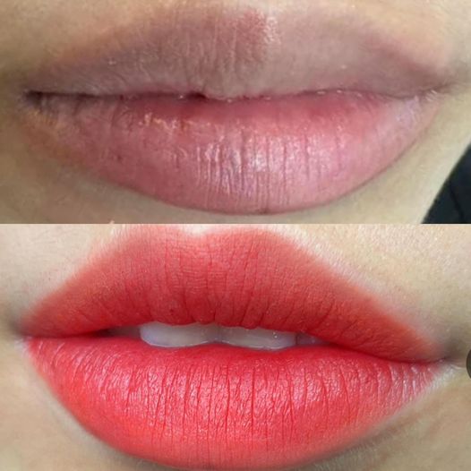 Khử Thâm Môi Bằng Laser 21