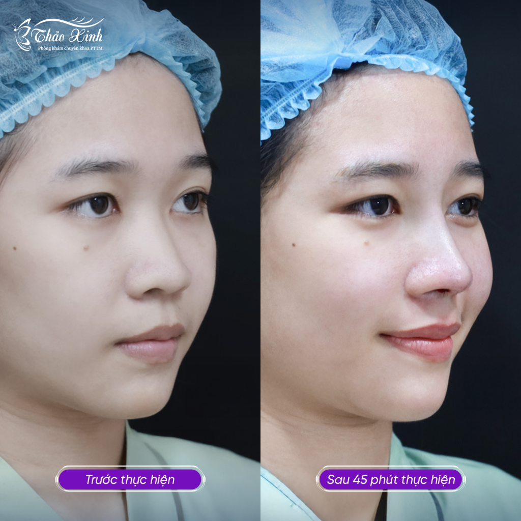 Nâng Mũi Bán Cấu Trúc 8