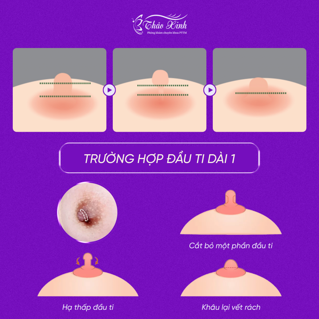 Phẫu Thuật Tạo Hình Đầu Ngực 5