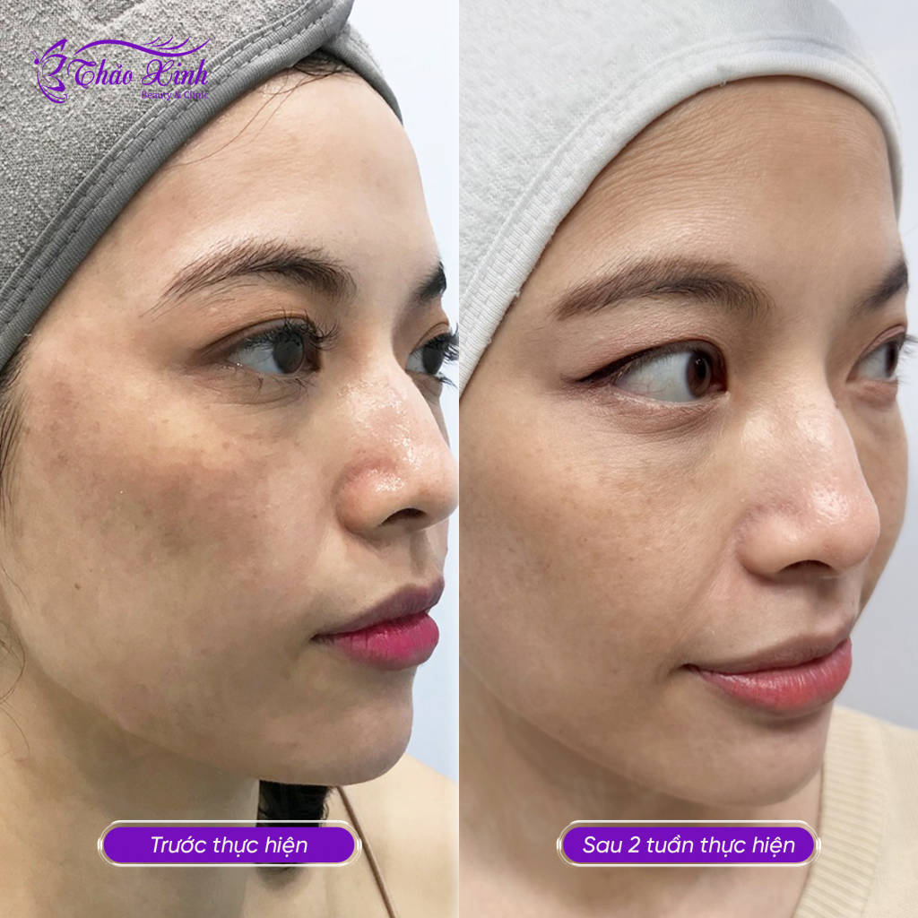 Điều Trị Nám Đốm "Bớt Hori" 8