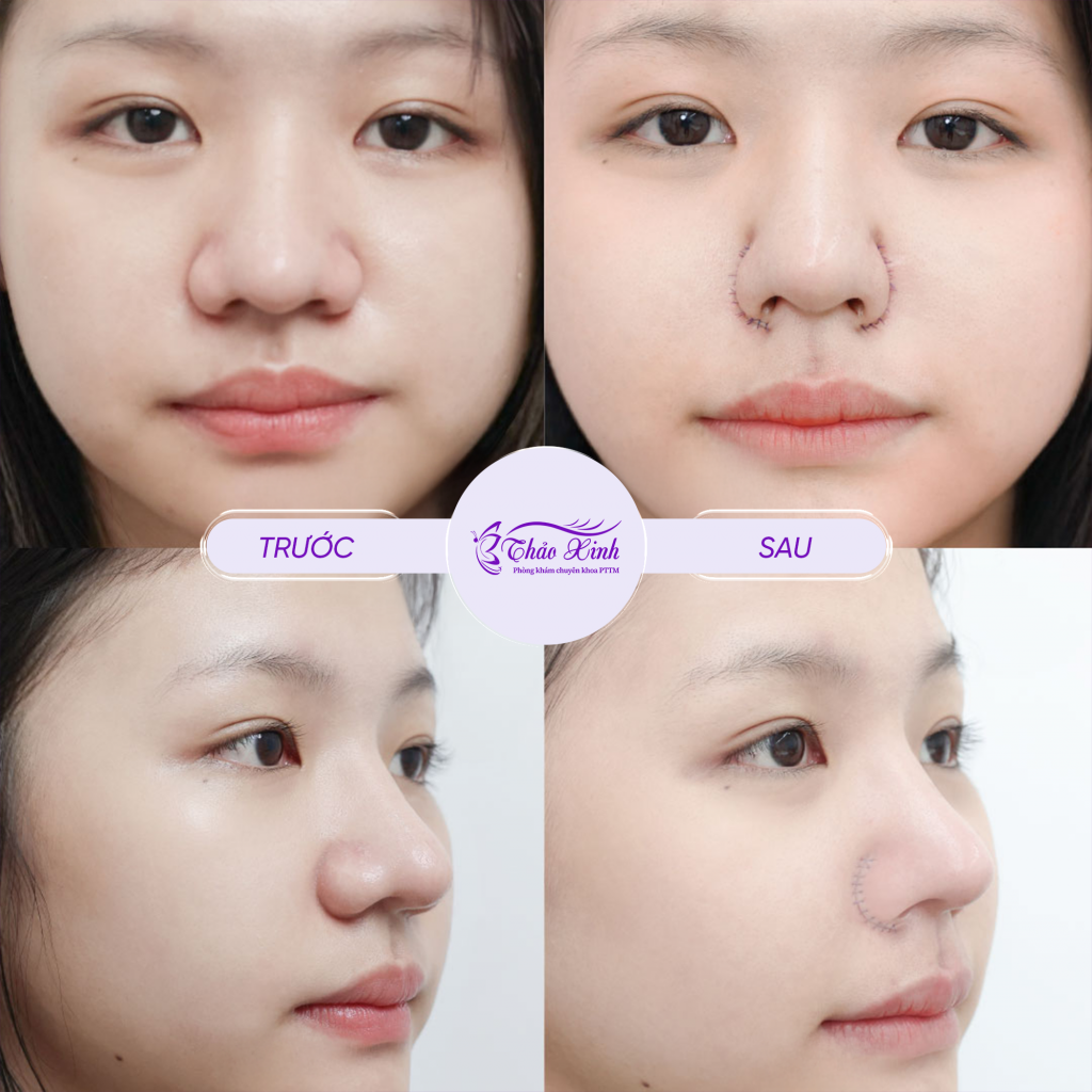 Thu Gọn Cánh Mũi “Cuộn + Cắt” 8