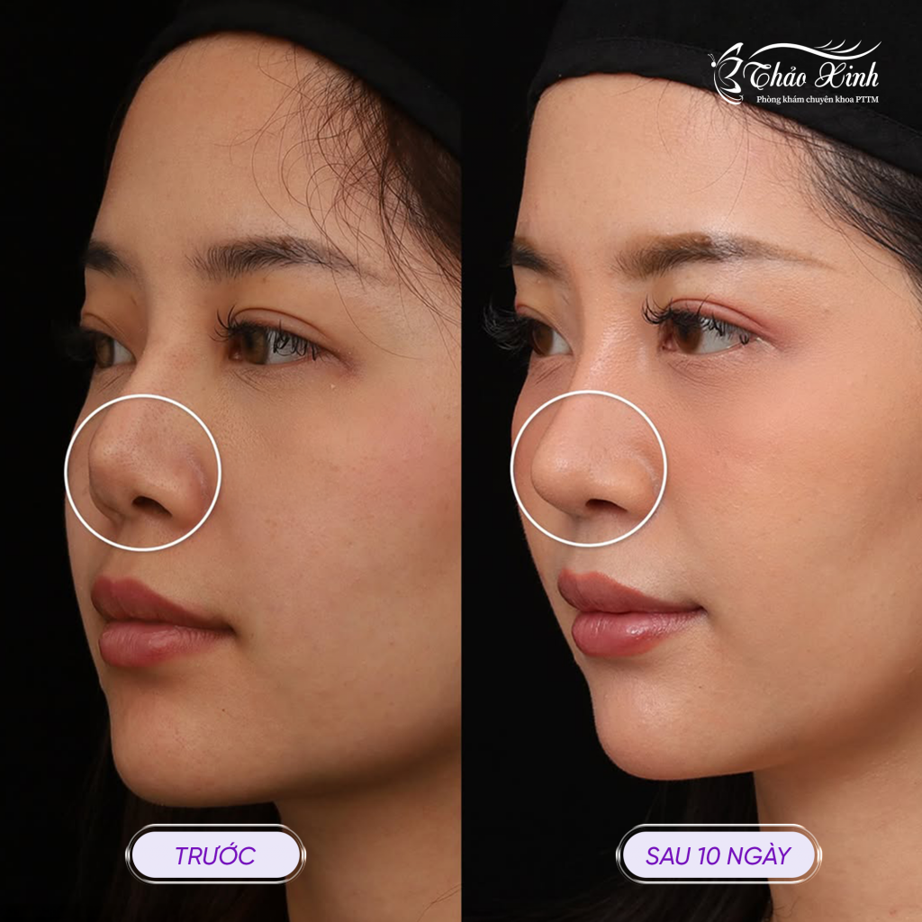 Xử Lý Mô Sơ Mũi 3