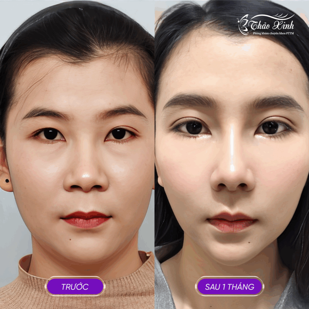 Cắt Mắt Hai Mí Trên, Mí Dưới 6