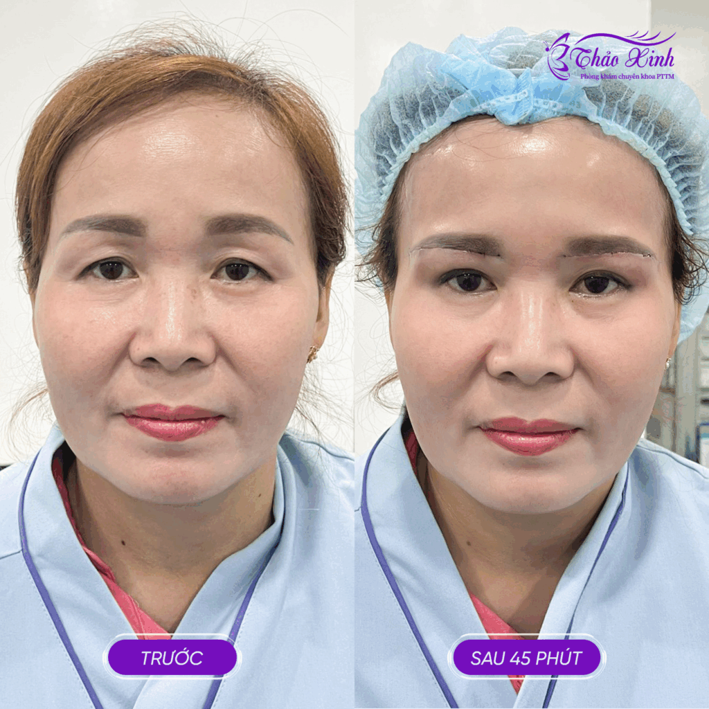 Nâng Cung Mày Cơ Bản 6