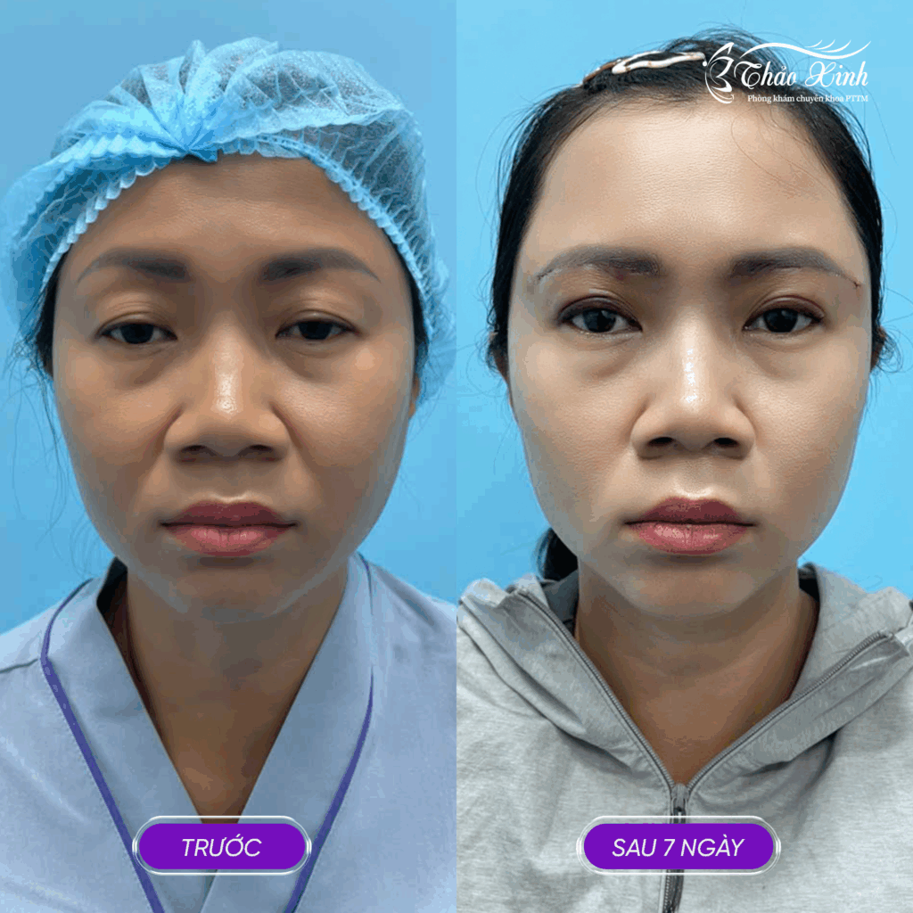 Nâng Cung Mày Rút Chỉ 8