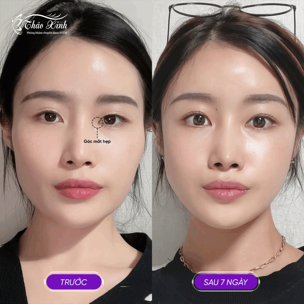 Mở Rộng Góc Mắt Trong/Ngoài 4