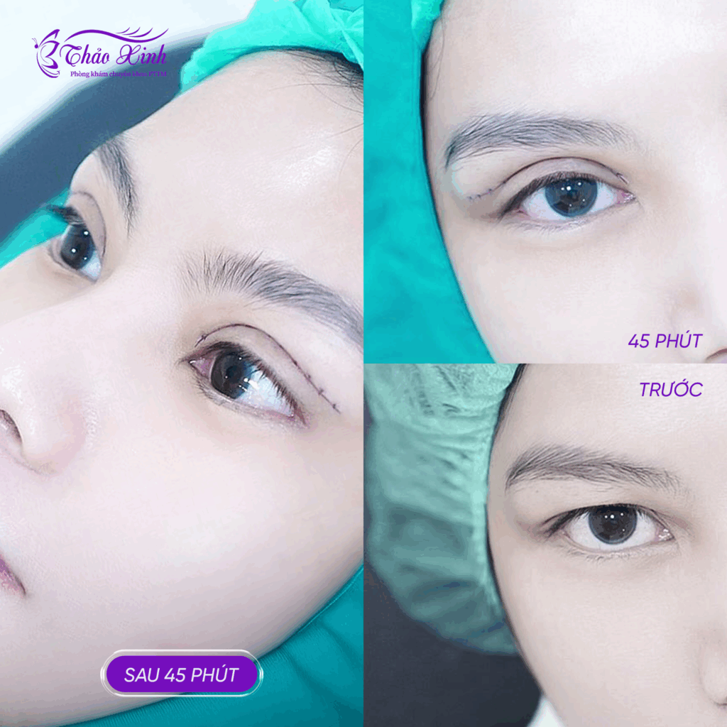 Lấy/Bóc Mỡ Mí Mắt 4