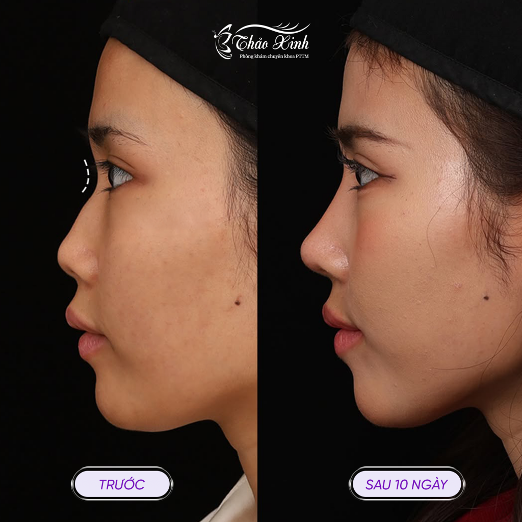 Cà Gồ Mũi 4