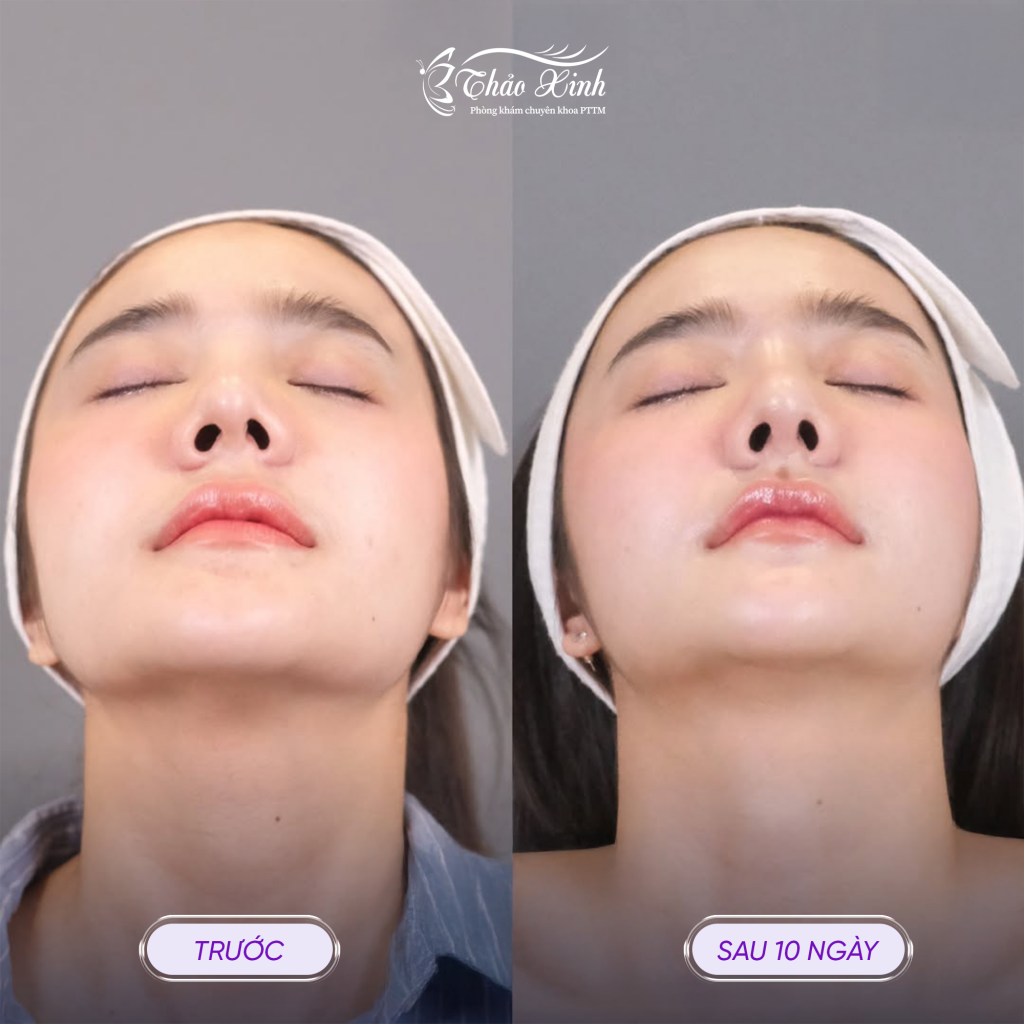 Tạo Hình Lỗ Mũi Hạt Chanh 5