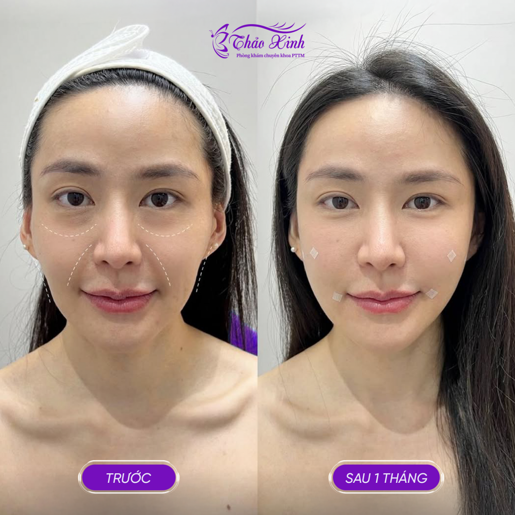 Làm Đầy Rãnh Cười Tự Thân 4