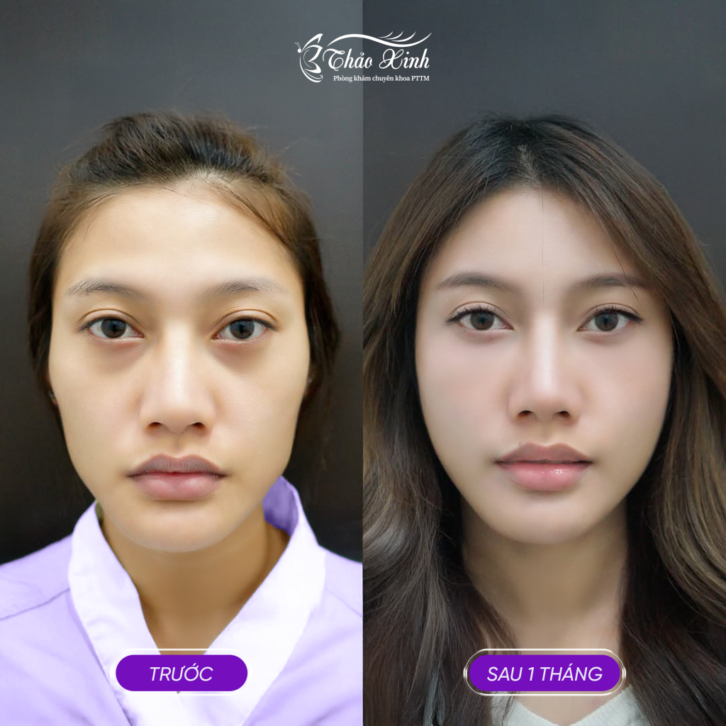 Cấy Mỡ Má Tự Thân 4