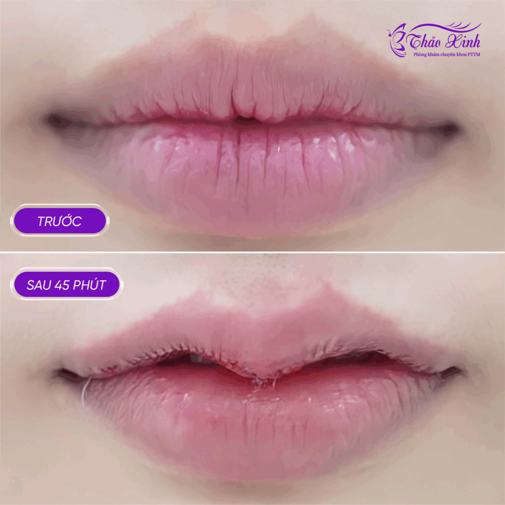 Tạo Hình Môi Trên 8