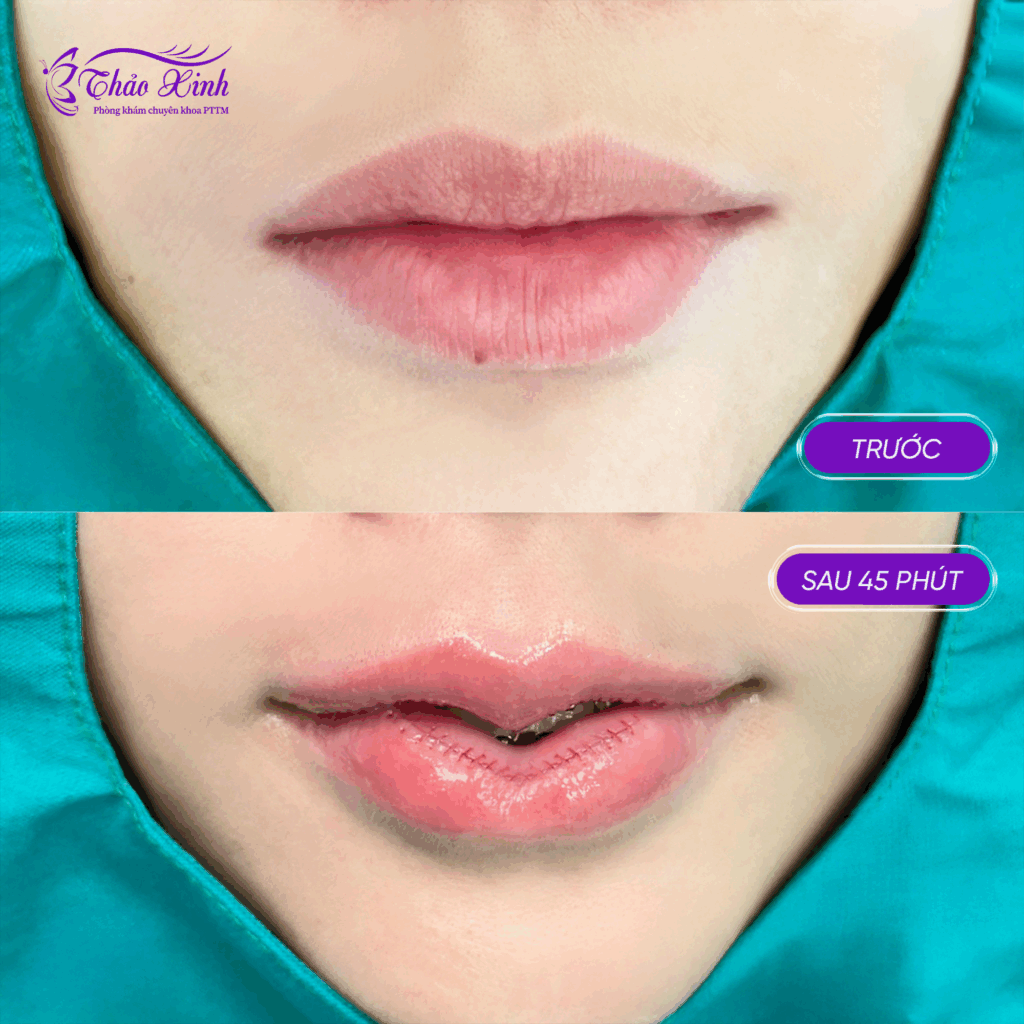 Tạo Hình Môi Dưới 6