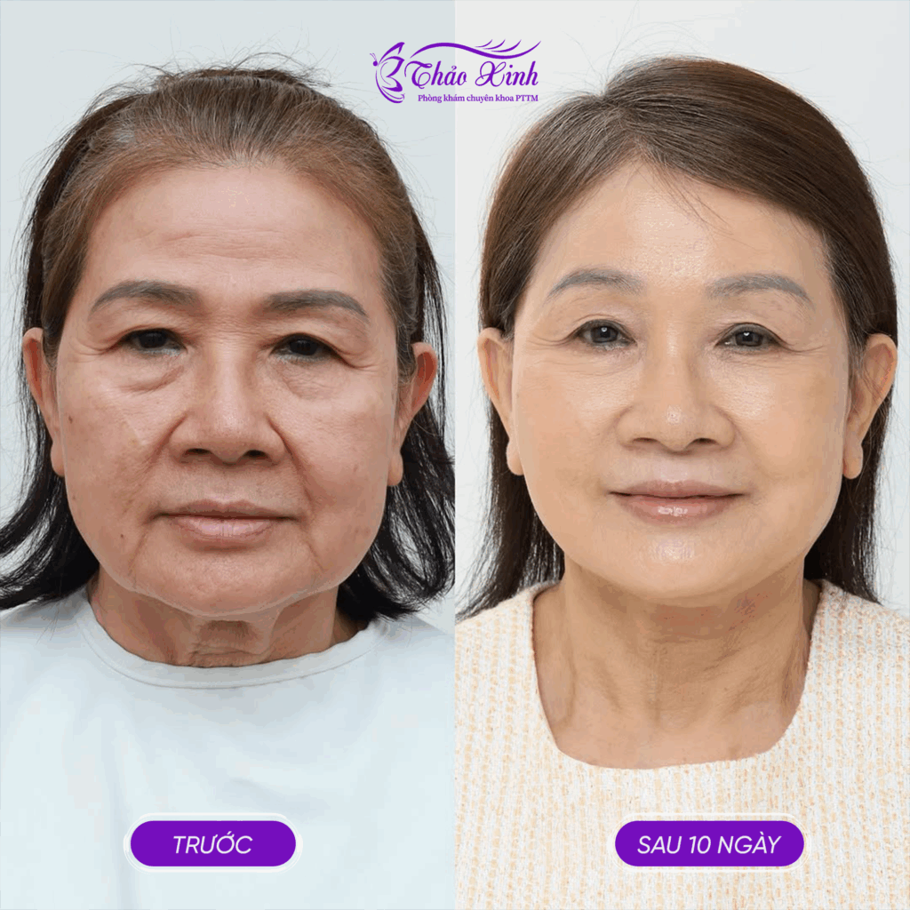 Căng Da Mặt Smas Face 5