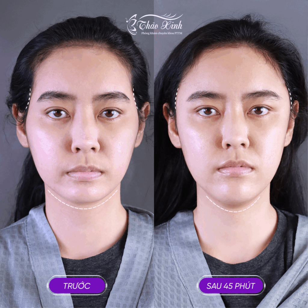 Độn Cằm Thái Dương 5