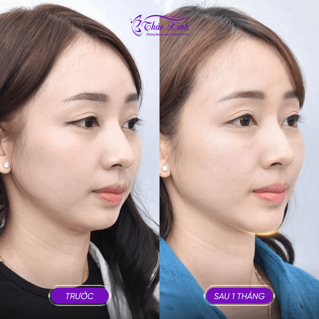 Độn Cằm V Line 6