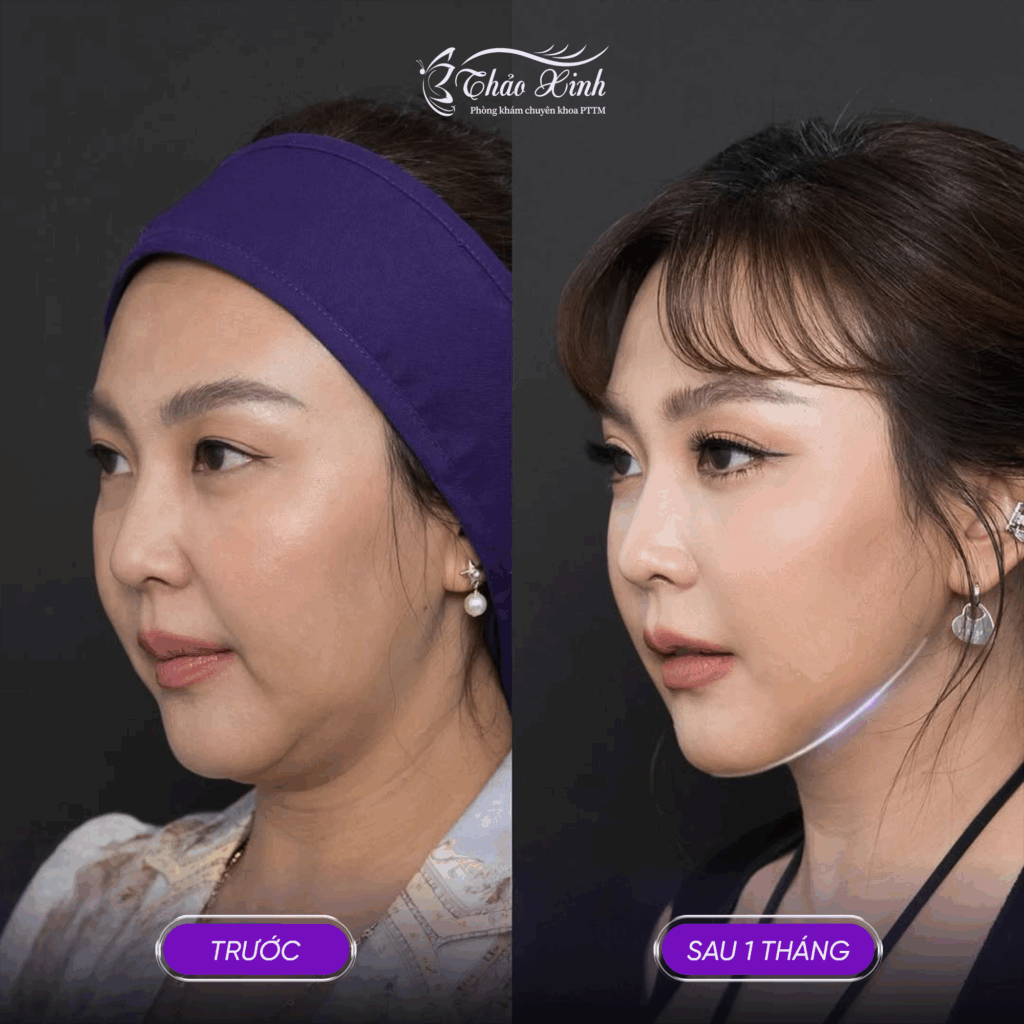 Lấy Mỡ Nọng Cằm 5