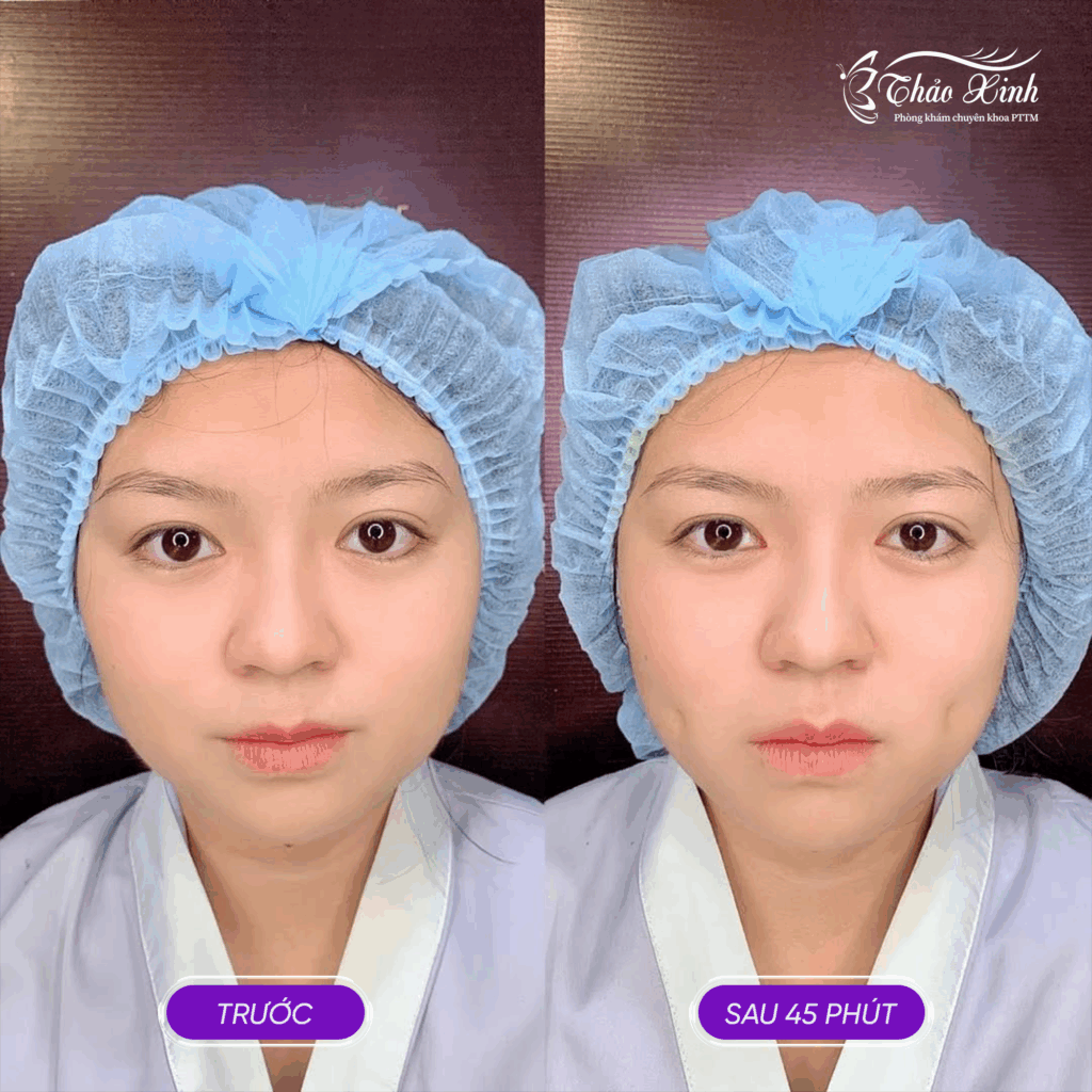 Tạo Má Lúm Đồng Tiền 4