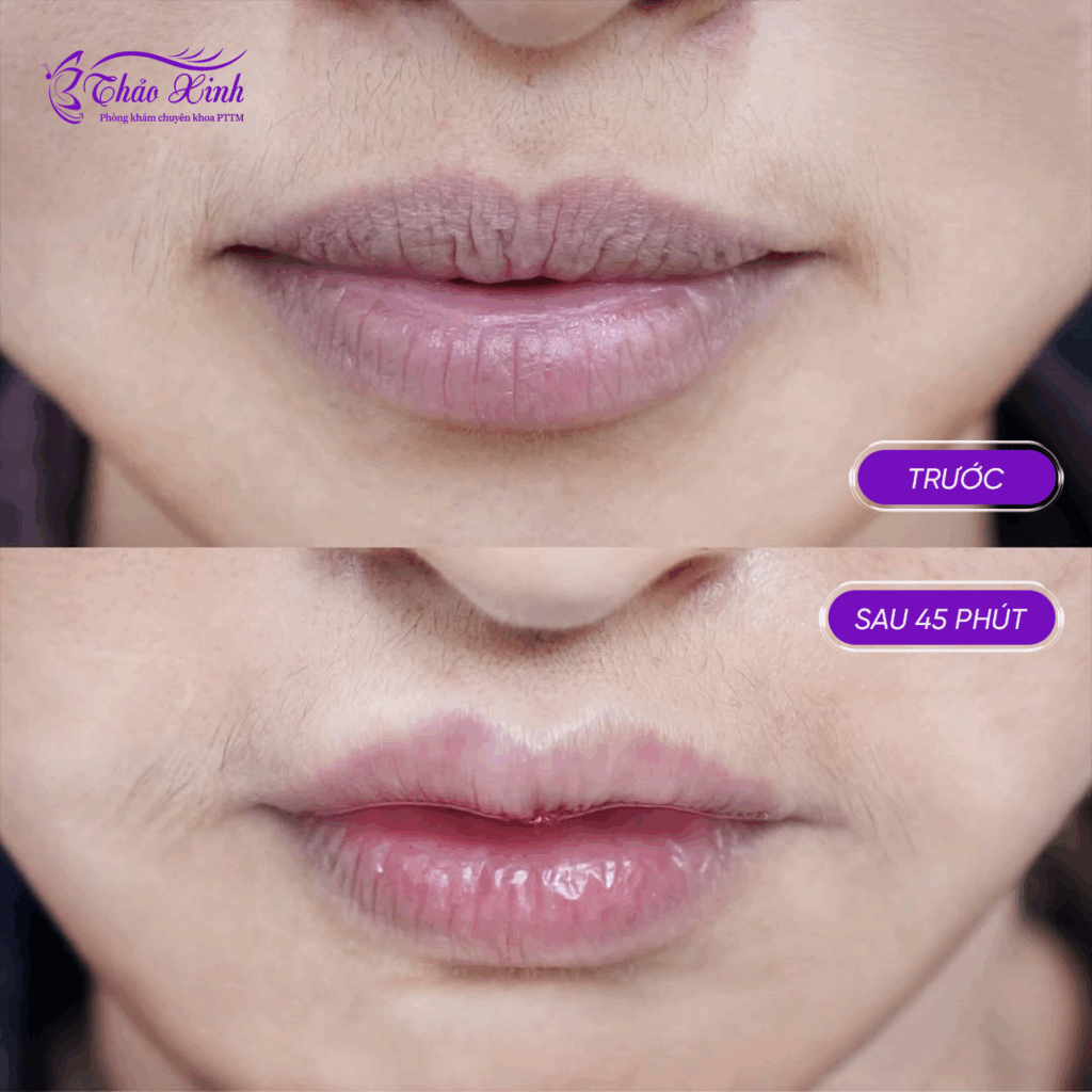 Tạo Hình Môi Trái Tim 6