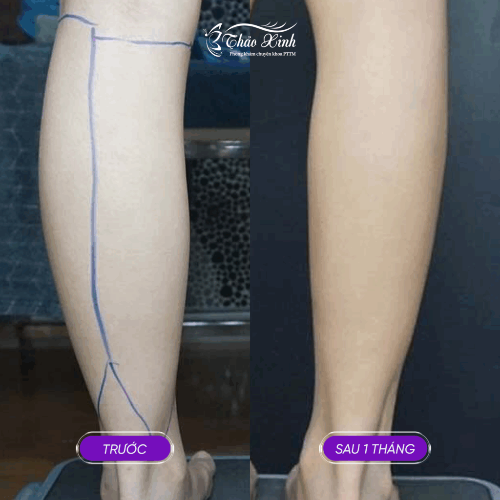 Hút Mỗ Vùng Bắp Chân 4