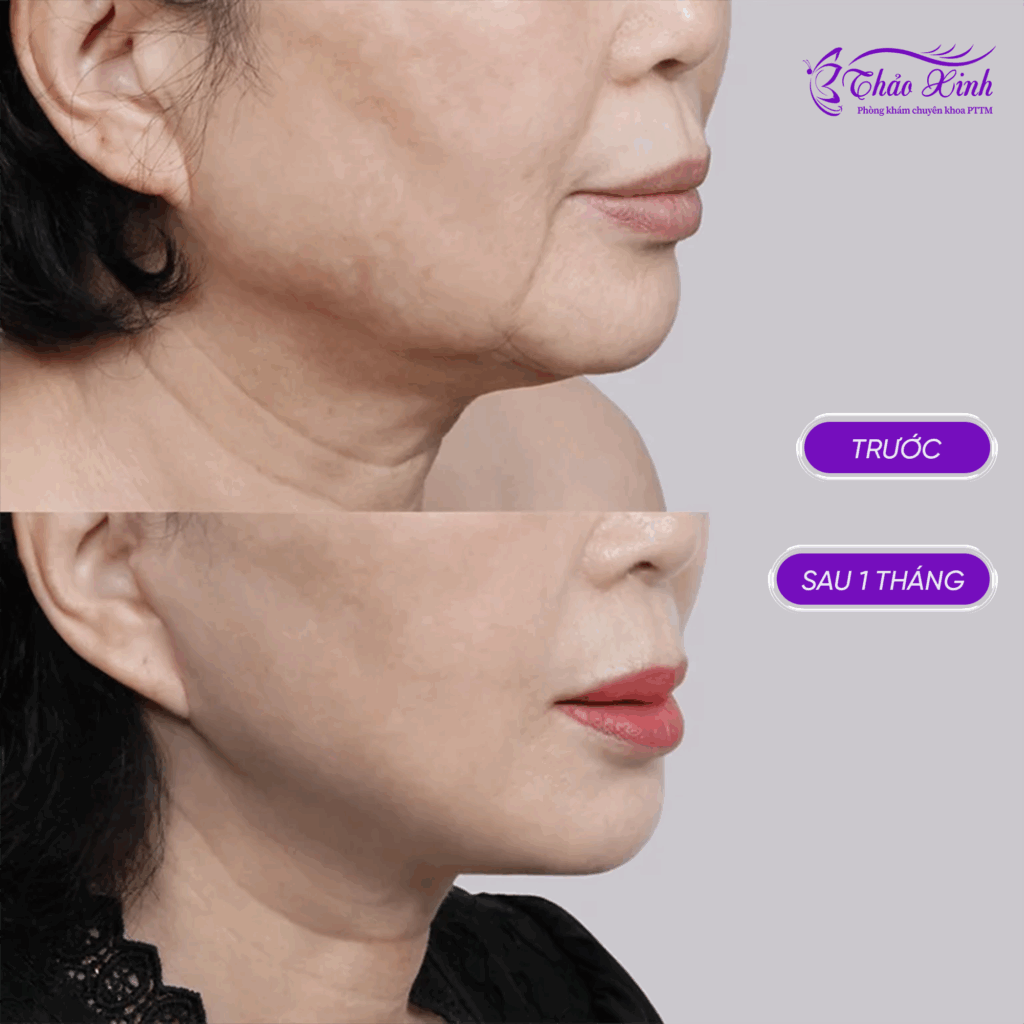 Căng Da Cổ Bán/Toàn Phần 4