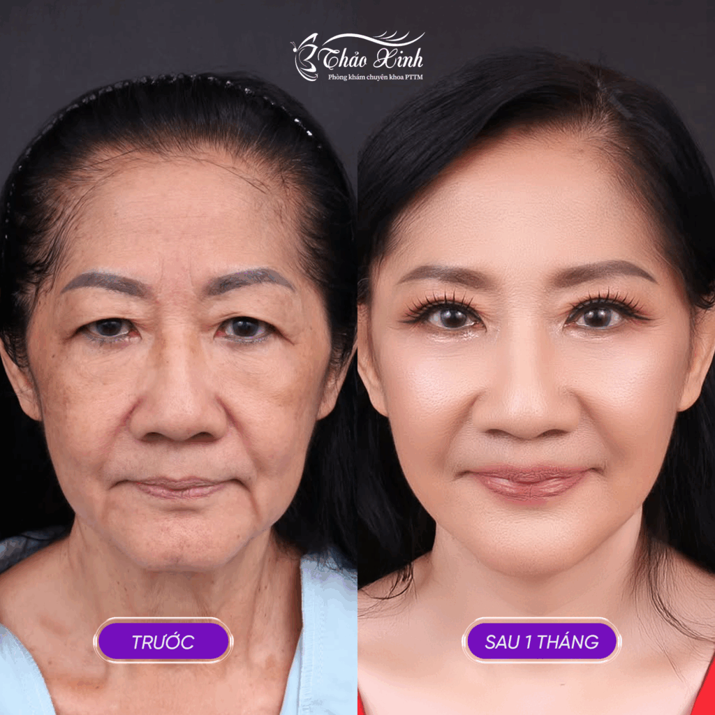 Căng Da Mặt Bán/Toàn Phần 4