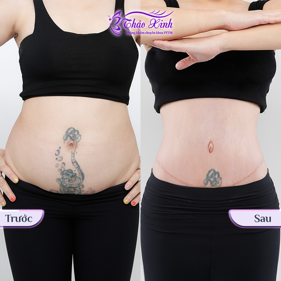 Căng Da Bụng Sau Sính Có Dời Rốn 6