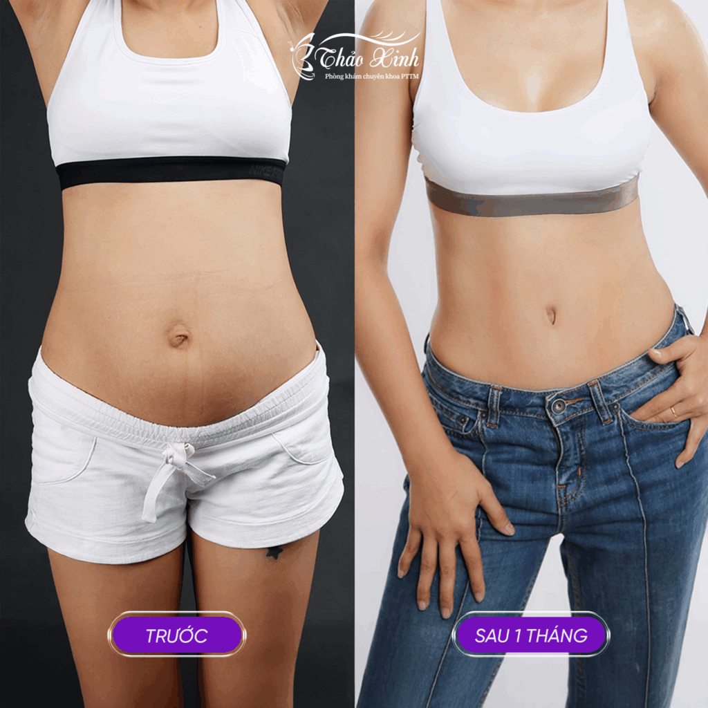 Căng Da Bụng Sau Sinh Không Dời Rốn 3