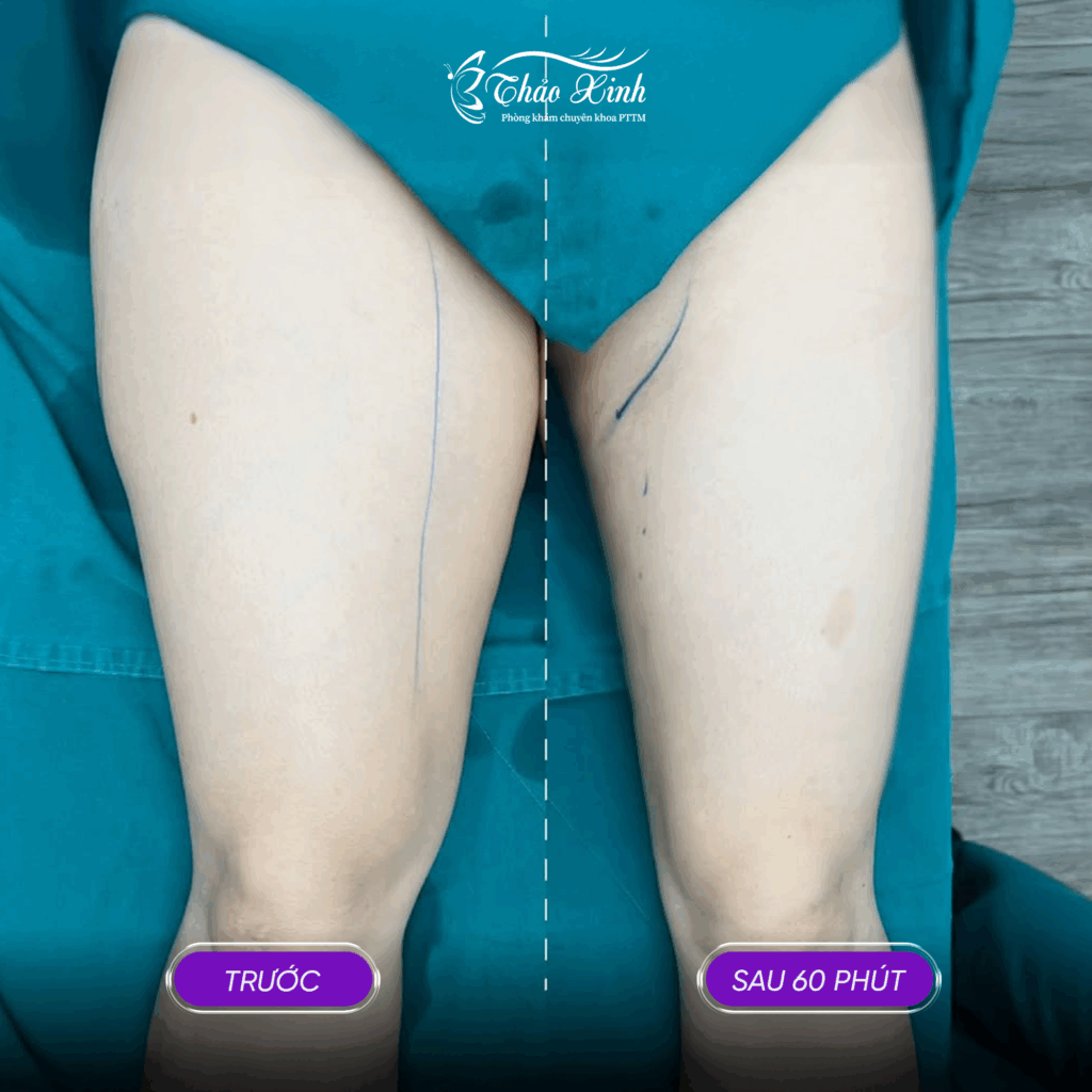 Hút Mỡ Vùng Đùi 3