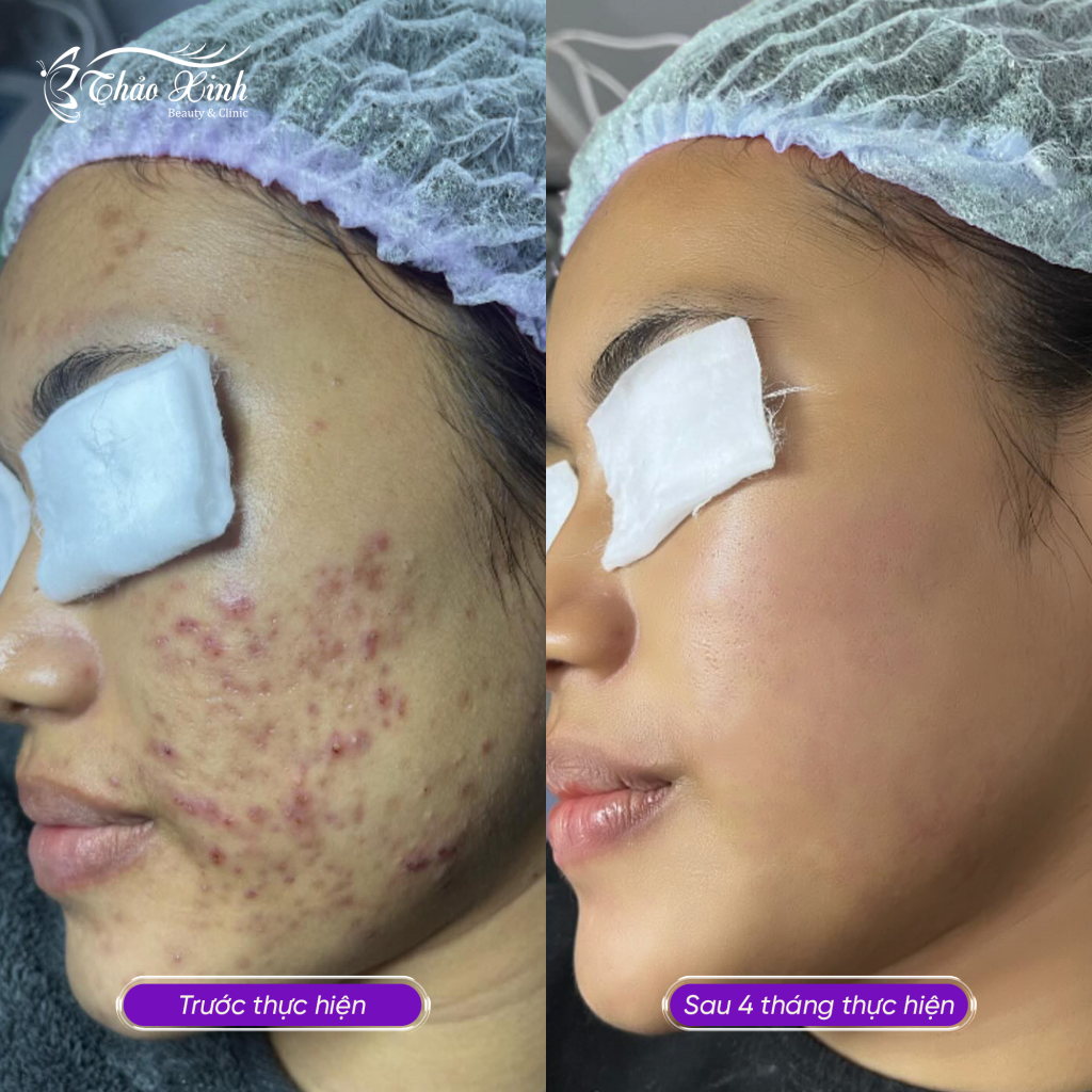 Điều Trị Mụn Bọc 6