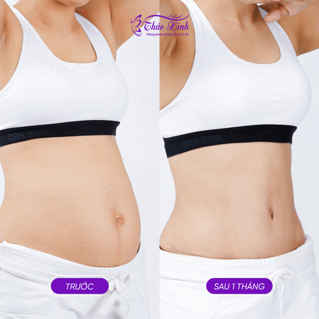 Hút Mỡ Vùng Bụng Trên/Dưới 4