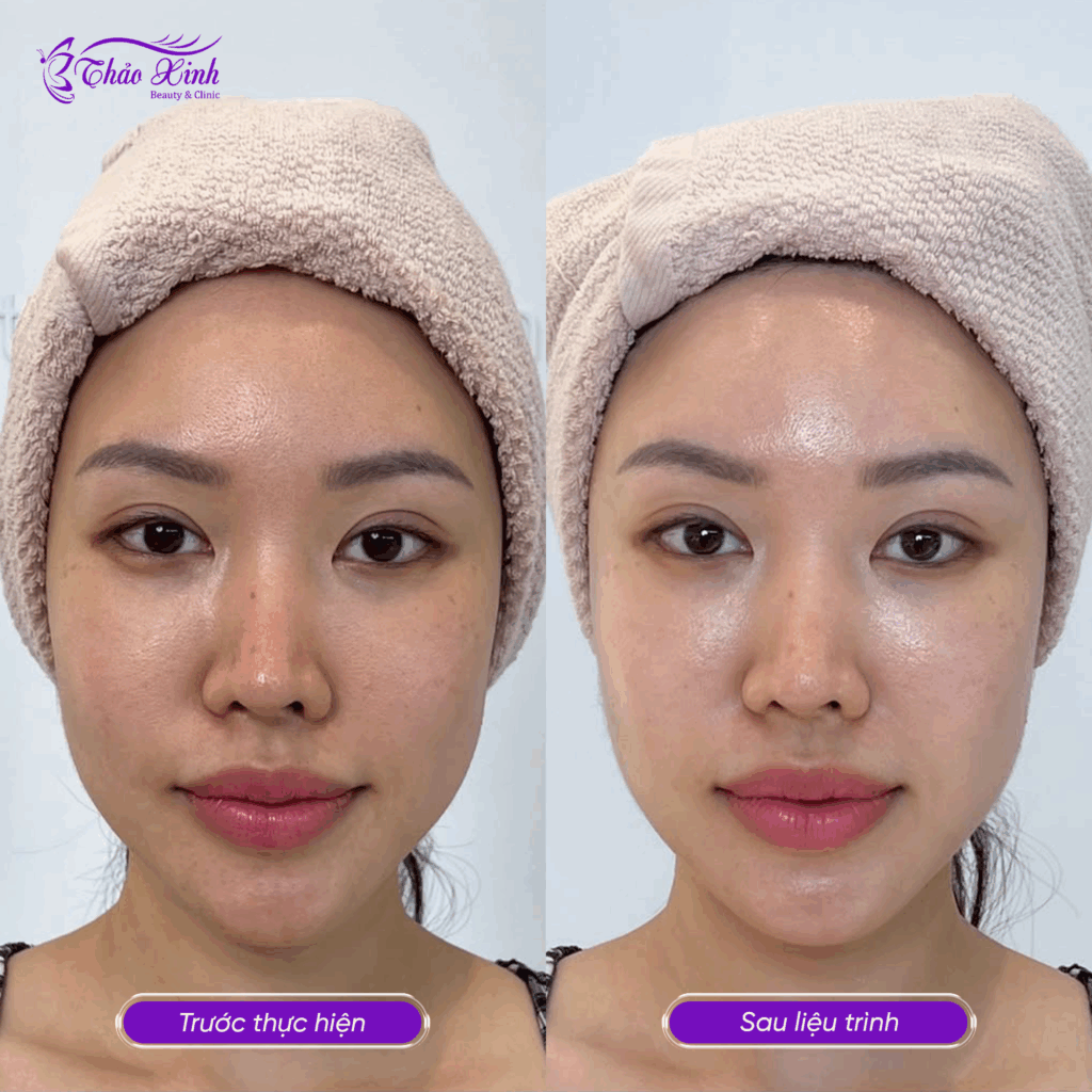 Chăm Sóc Da Chuyên Sâu 4