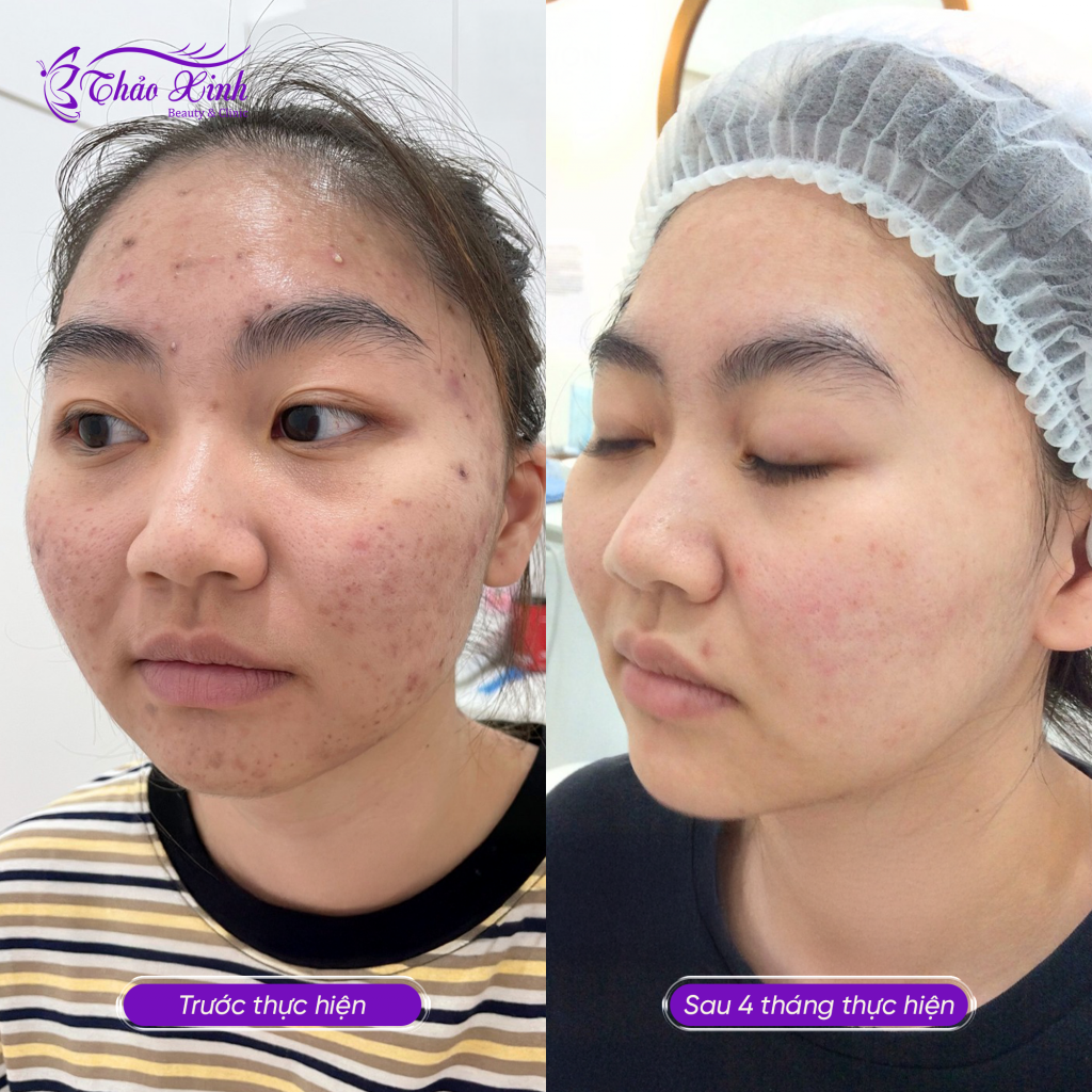 Điều Trị Mụn Dậy Thì 8
