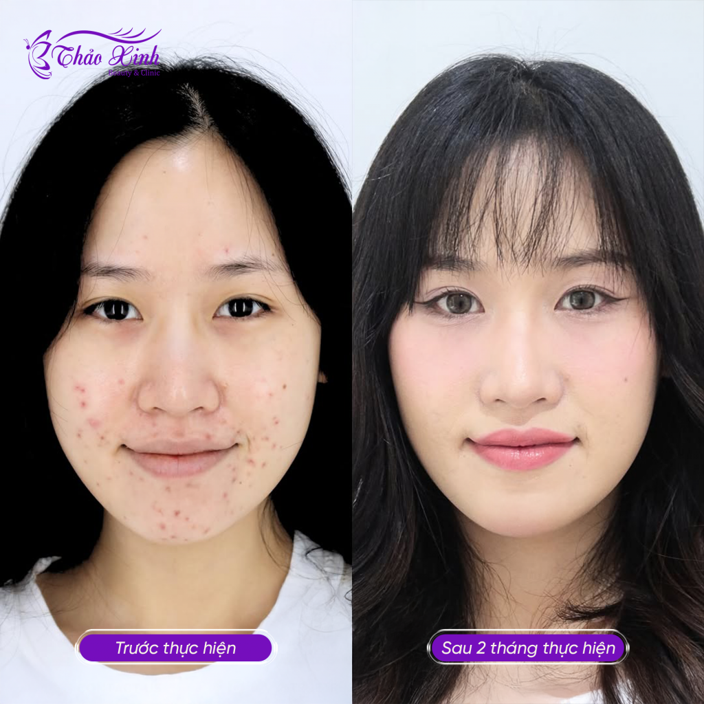 Điều Trị Mụn Trứng Cá 8