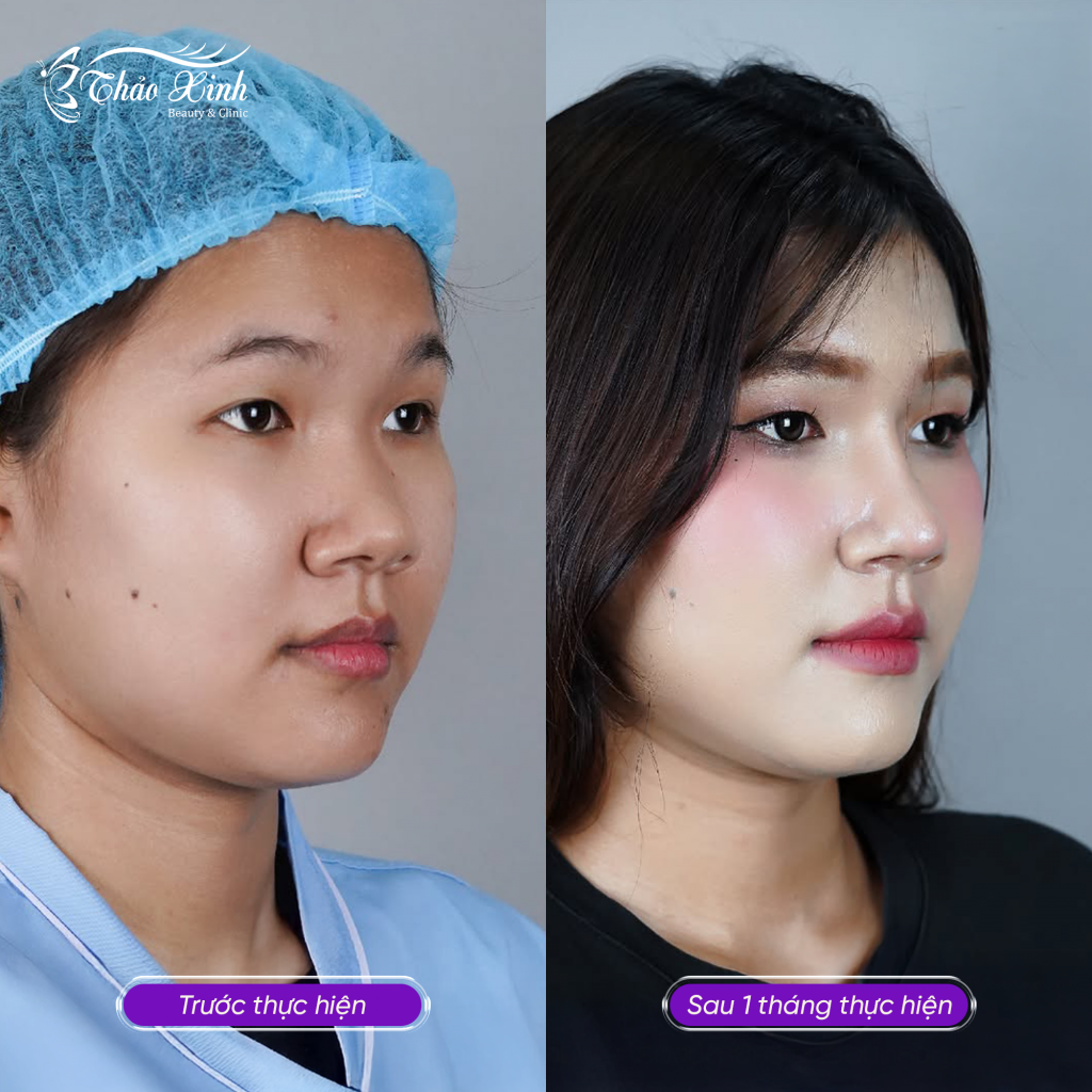Nâng Mũi Sụn Hàn Quốc 6