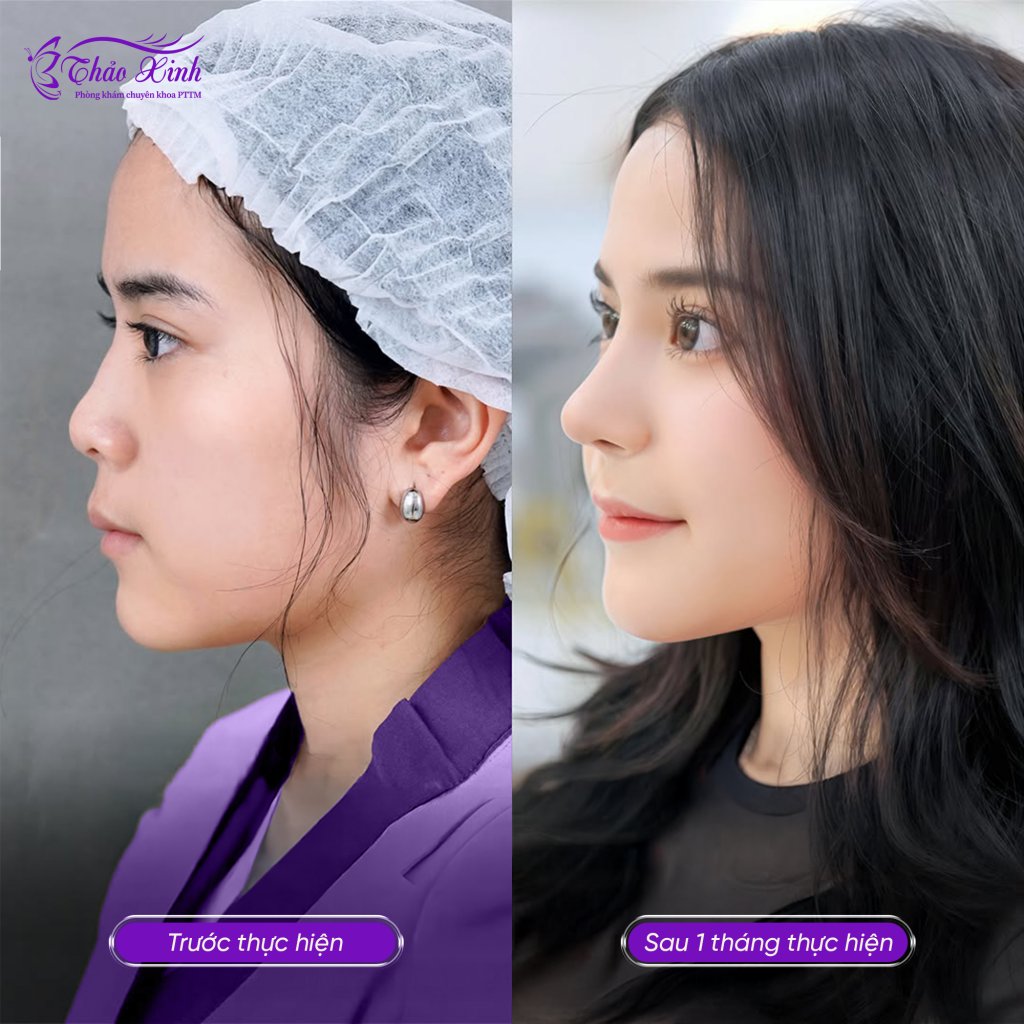 Nâng Mũi Sụn Surgiform 6