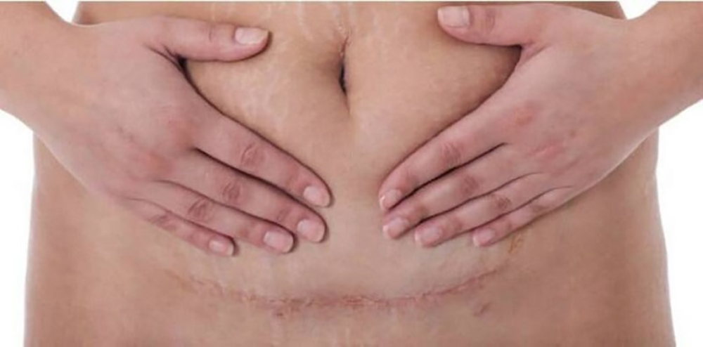 Điều Trị Sẹo Sau Sinh 6