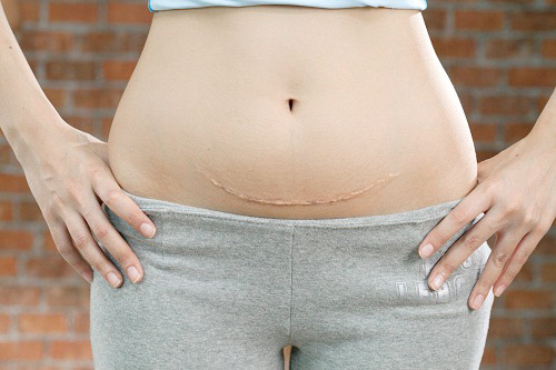 Điều Trị Sẹo Sau Sinh 4