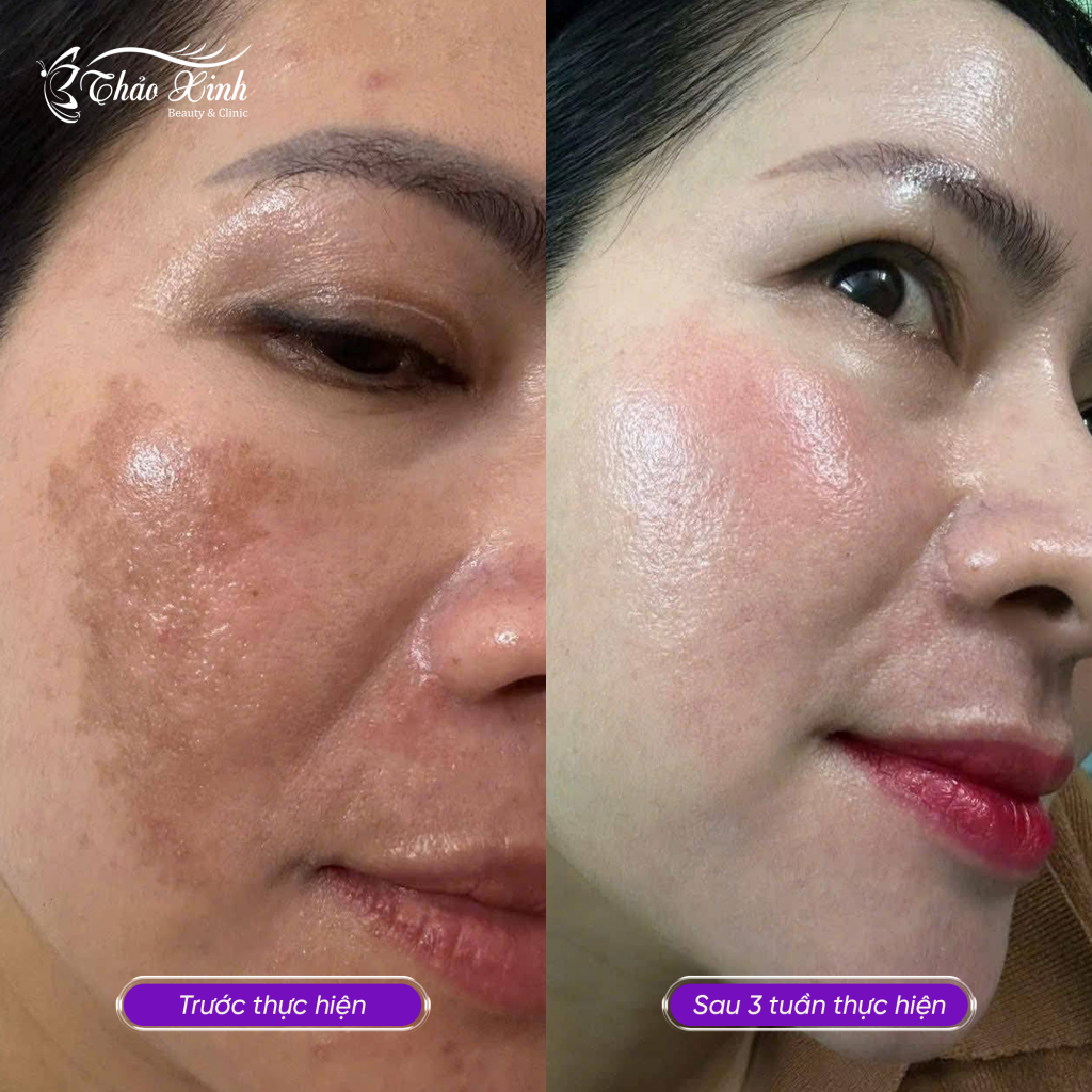 Điều Trị Nám Mảng 6
