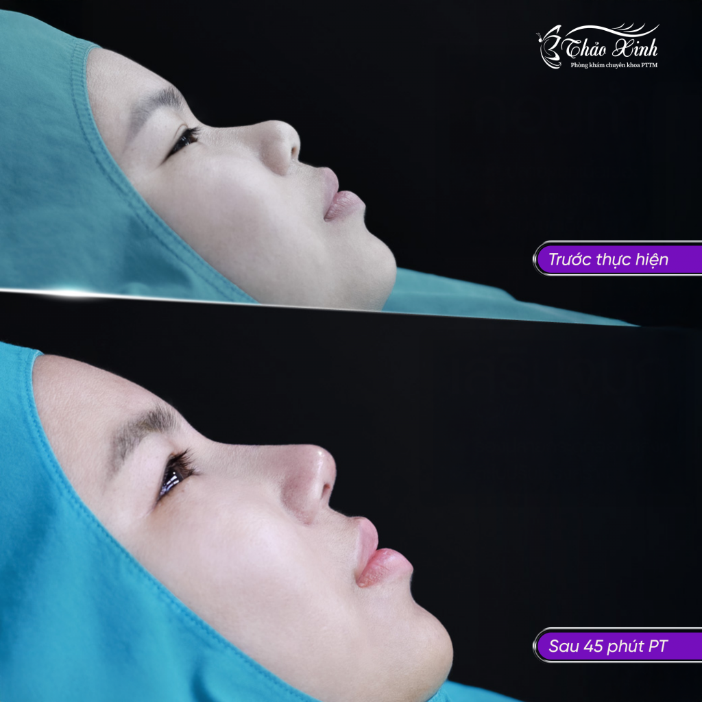 Nâng Mũi Sụn Tai 5