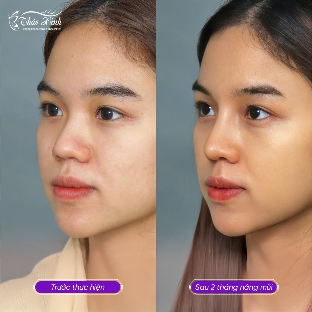 Nâng Mũi Bán Cấu Trúc 7