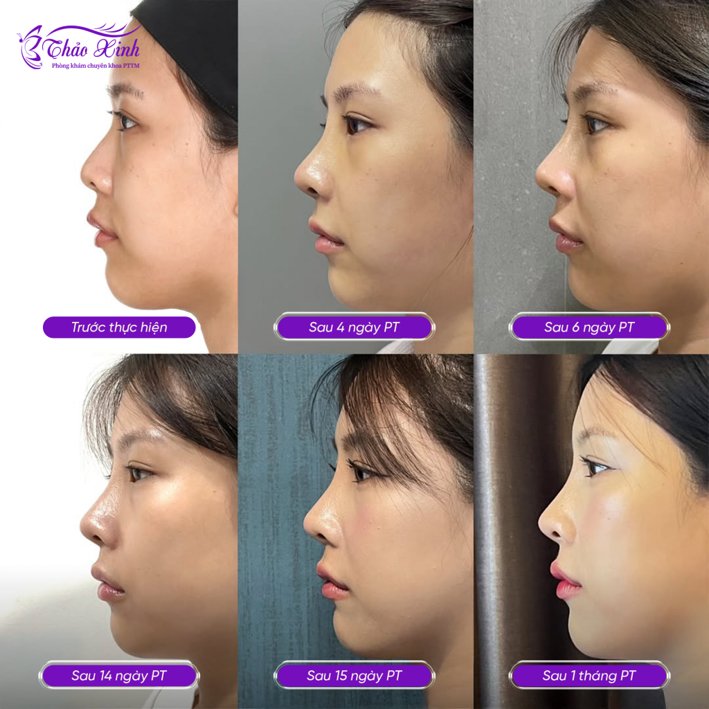 Nâng Mũi Cấu Trúc Kín 4