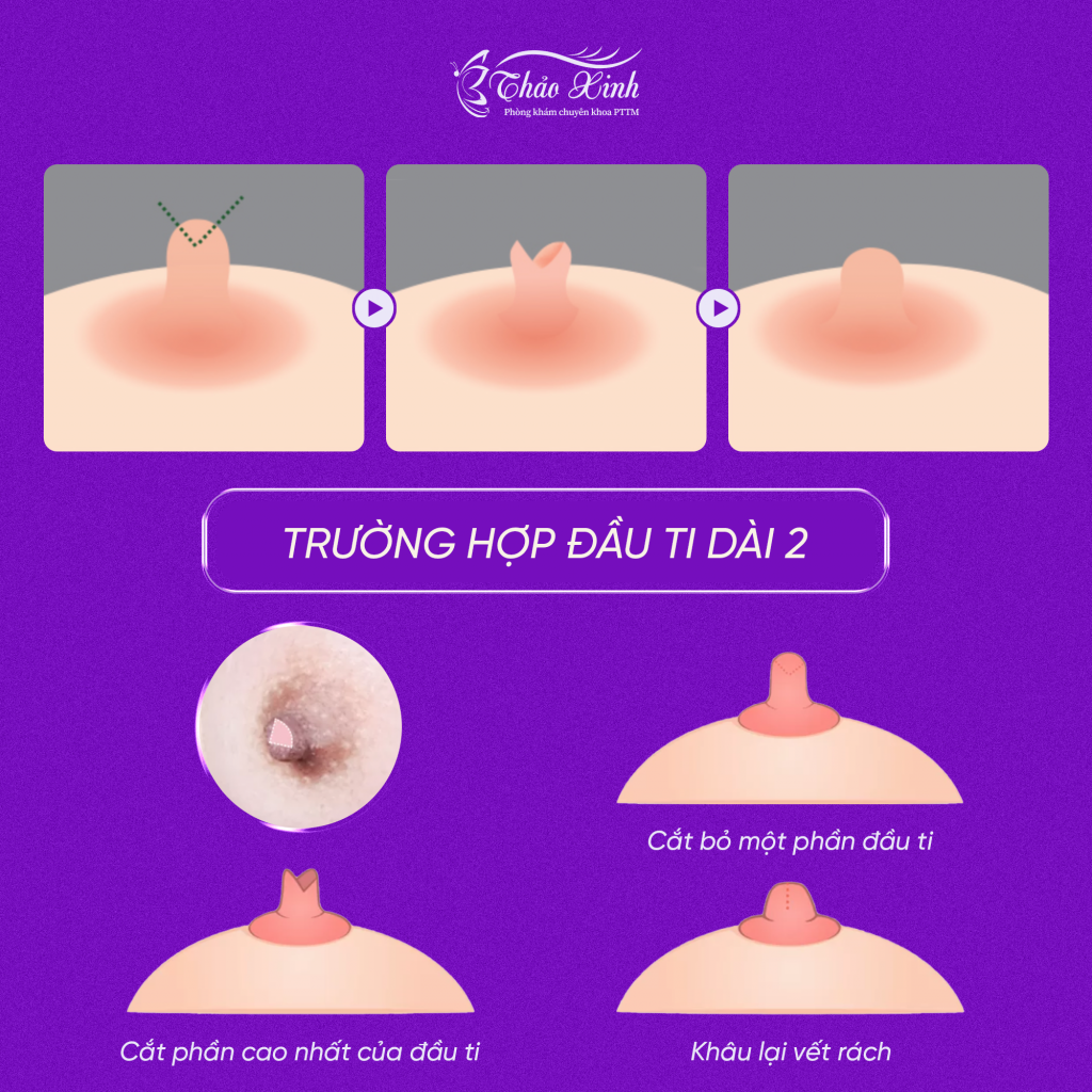 Phẫu Thuật Tạo Hình Đầu Ngực 8