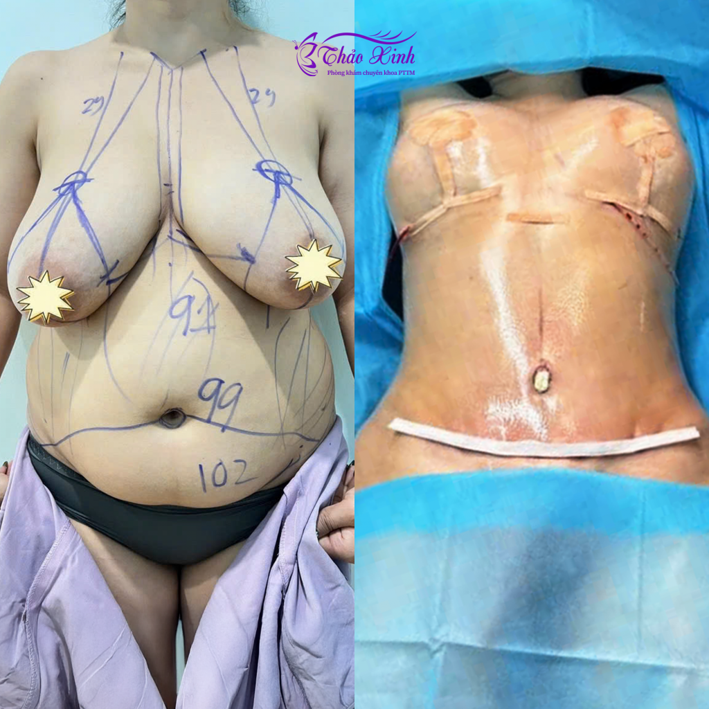 Treo Sa Trễ Chỉnh Hình Ngực 5