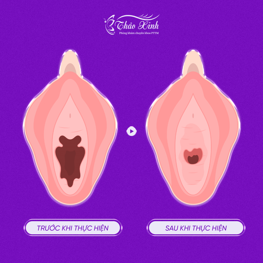 Thu Nhỏ Môi Bé Toàn Diện 3