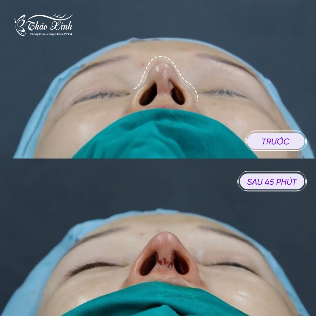 Xử Lý Mô Sơ Mũi 4