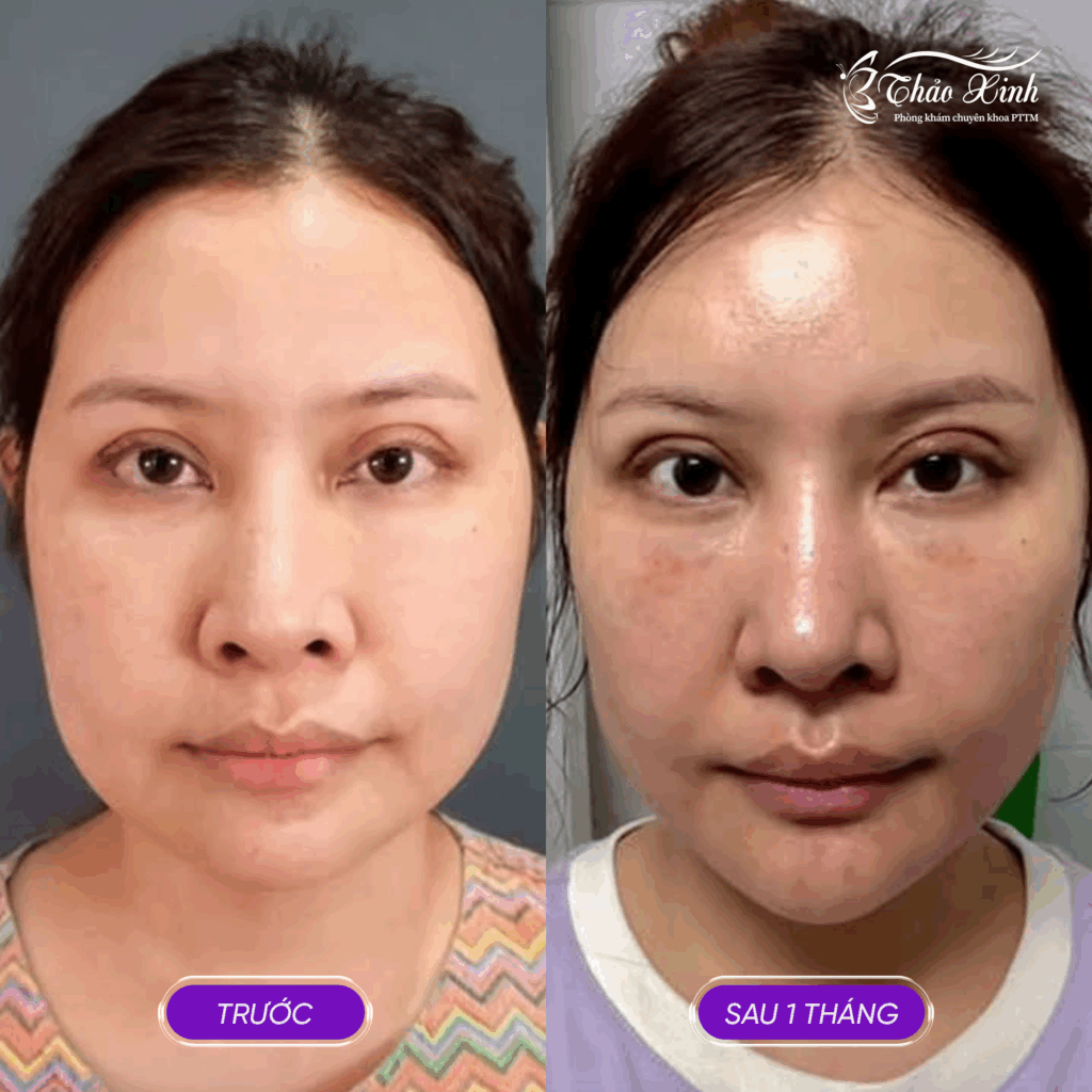 Cắt Mắt Hai Mí Trên, Mí Dưới 5