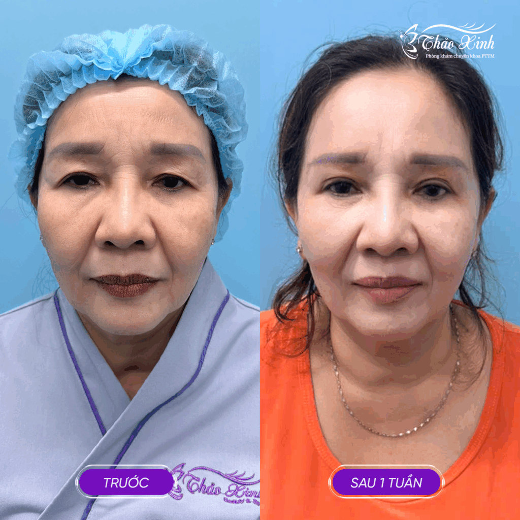 Nâng Cung Mày Cơ Bản 5