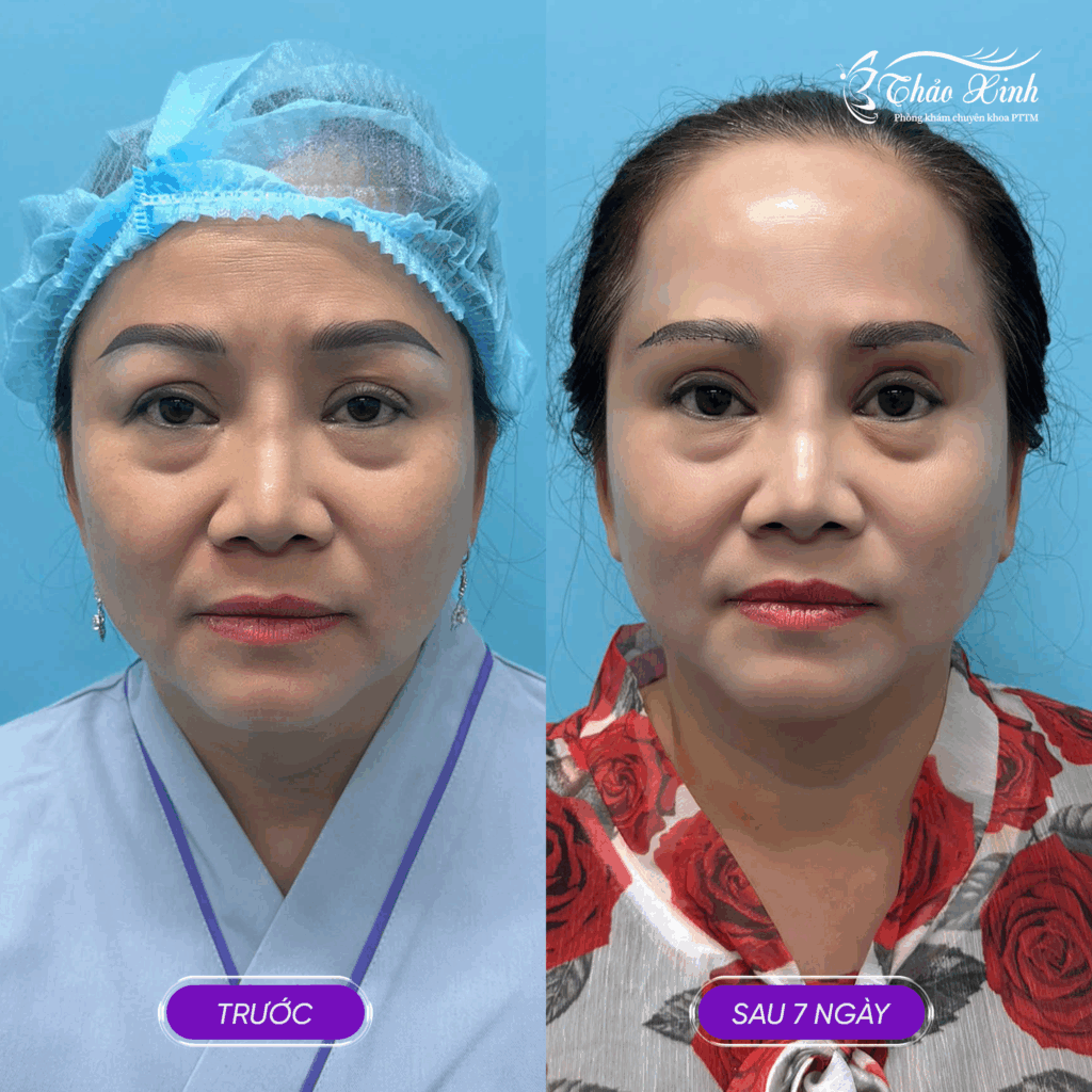 Nâng Cung Mày Rút Chỉ 7